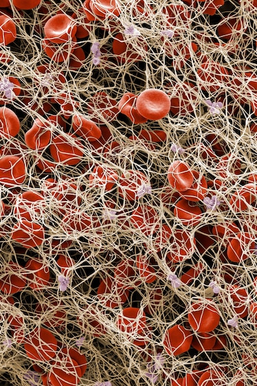 Colored scanning electron micrograph of a blood clot, showing red blood cells and platelets in a fibrin mesh.