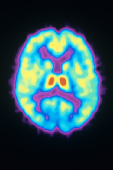 A colorized Positron Emission Tomography (PET) scan showing the distribution of opioid receptors in the human brain.